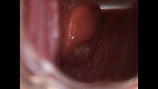 Avy Aberto Bichano con Speculum